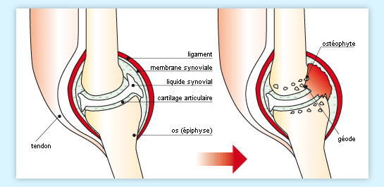 Arkopharma Chondro-Aid - Le Cartilage Articulaire : Manifestation ...